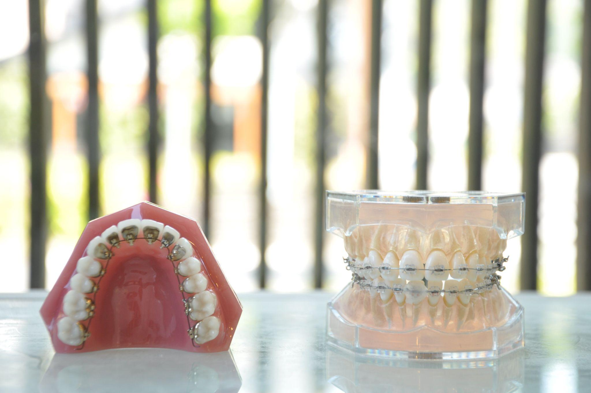 歯科矯正の費用が高くなる要因