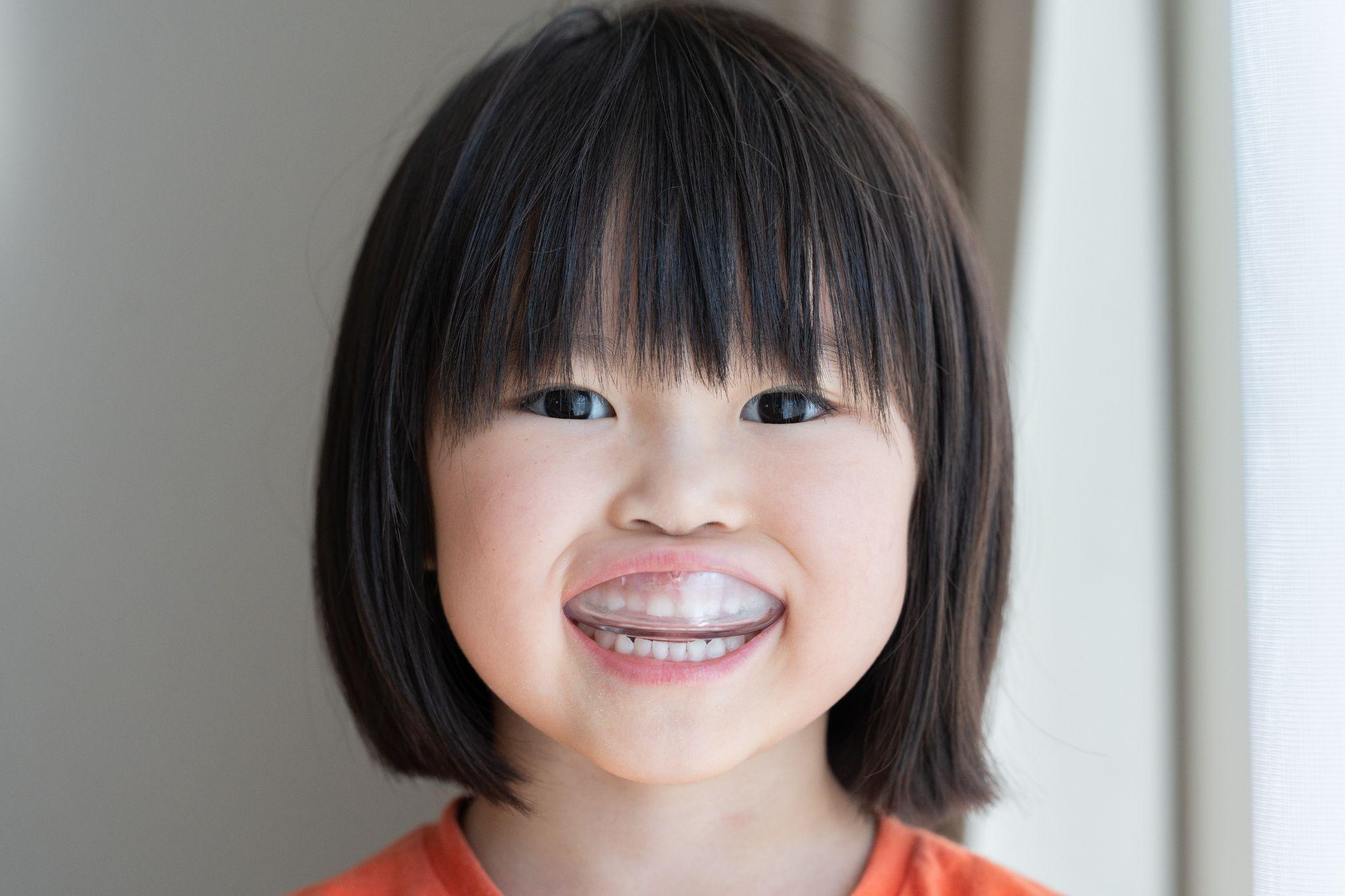 小児のマウスピース矯正の効果