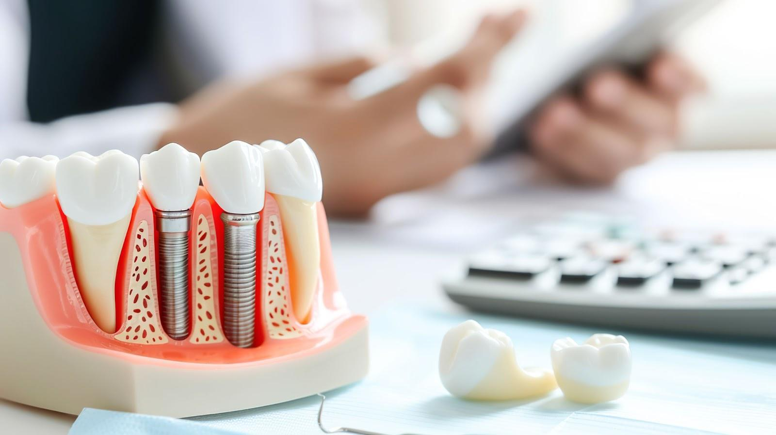 インプラントの医療費控除額の計算式と例