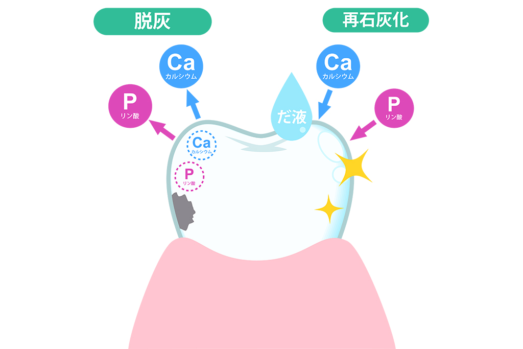 むし歯予防のためのフッ素塗布